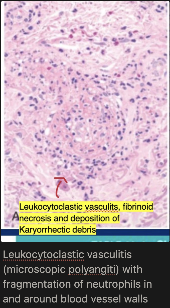 <p>Segmental necrotizing vasculitis of capillaries/arterioles/venules; fibrinoid necrosis of media; leukocytoclastic vasculitis (karyorrhectic debris of neutrophils); all lesions are SAME age; pauci-immune on immunofluorescence</p>