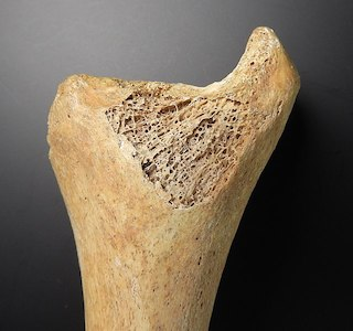<p>More porous than compact bone</p>