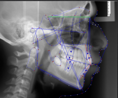 <p>which reference plane:</p><p>- Sella to Nasion</p><p>- Cranial base reference line</p><p>- According to Bjork, the cranial base grows along the Sella Nasion line</p>