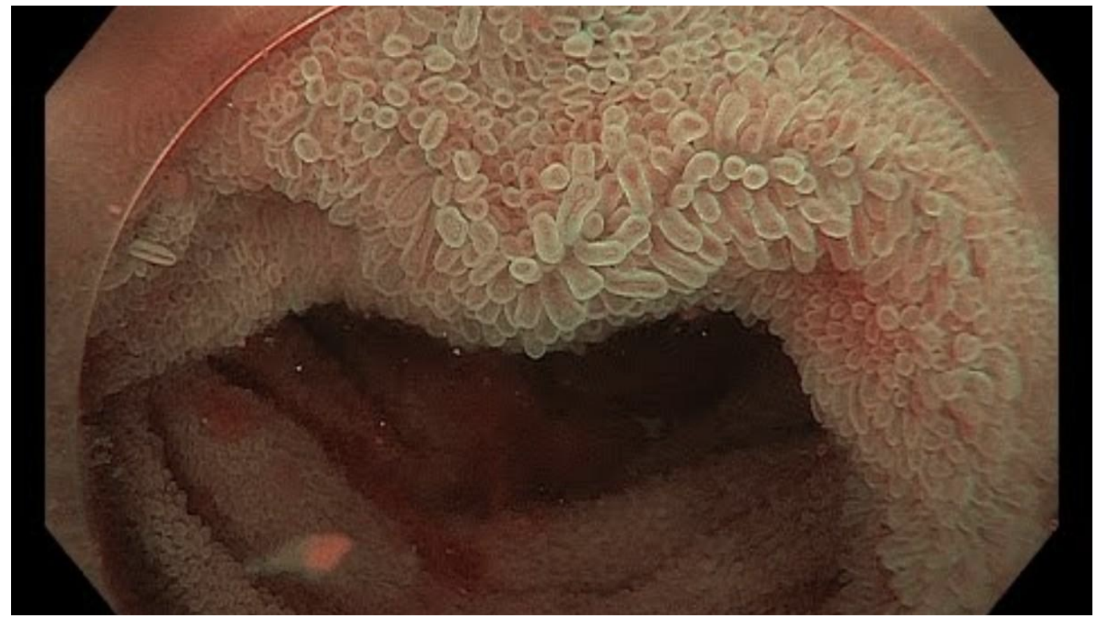 <p><strong>-Gastroileal reflex:</strong> opens ileocecal valve in response to stretch in stomach (*between SI and LI)</p><p>-Stretch also causes mass movements, powerful peristaltic contractions that move material through the colon (<strong>gastrocolic reflex</strong>) (*why a meal triggers bowel movement)</p><p><strong>-Defecation reflex</strong> triggered by stretch in rectum</p>