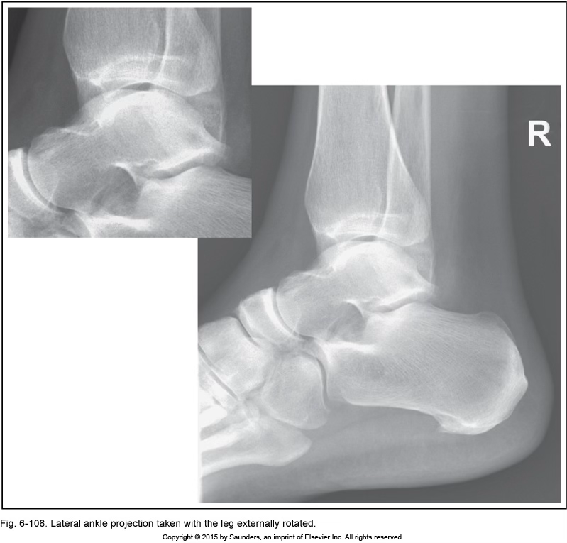 <p>lateral ankle</p>