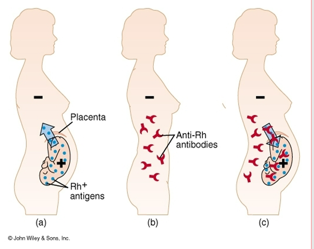 <p>Rh+ individuals</p><p>– Have Rh antigens on their red cells (No anti-D antibodies unless exposed)</p><p>– Most common</p><p>• Rh- individuals</p><p>– Have no Rh antigens (may produce anti-D if exposed to Rh+ blood)</p><p>– Have no Rh antibodies at first</p><p>If an Rh- individual receives Rh+ blood</p><p>– The first time no problem but</p><p>• Rh- person makes Rh antibodies</p><p>– The second time Rh antibodies will clump with Rh+ blood</p><p><span style="font-family: Arial, sans-serif;"><strong>Can be present (+ or D) or absent (- or d)</strong></span></p><p class="MsoNormal">o<span style="font-family: "Times New Roman"; line-height: normal; font-size: 7pt;"> </span><strong>Rh+</strong> can receive from <strong>both + and –</strong></p><p class="MsoNormal">o<span style="font-family: "Times New Roman"; line-height: normal; font-size: 7pt;"> </span><strong>Rh–</strong> can <strong>ONLY receive ONLY from –</strong></p>