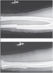 <p>Nightstick Fx: Mid-diaphysis (mid-shaft) ulnar fracture</p>