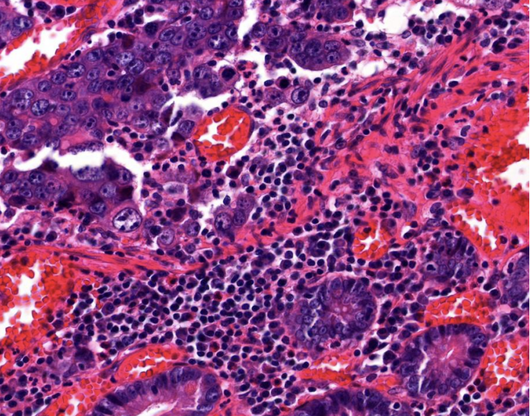 <p>the patient's biopsy histology, what is your favoured histological diagnosis? </p>