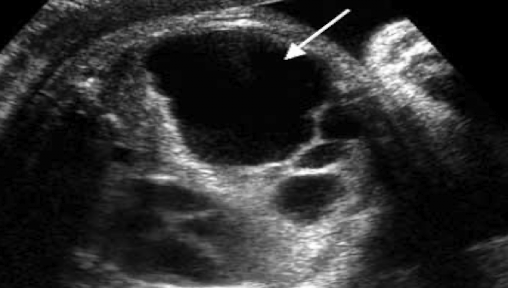 <ul><li><p>mainly cystic lesion </p></li></ul><p></p>