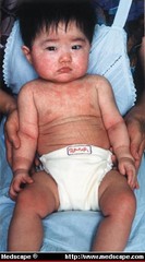 <p>-abrupt onset of high fever</p><p>-appearance of rash when fever resolves: generalized blanchable, maculopapular rash</p>