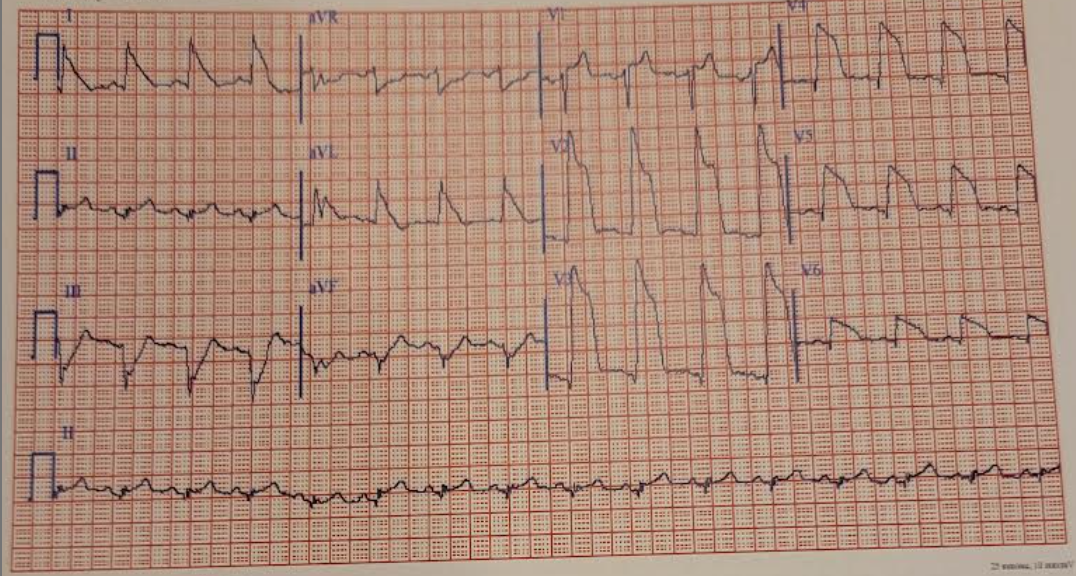 <p>howd yk this is antero-lateral wall acute myocardial infarction with injury</p>