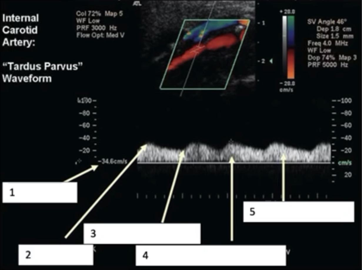 <p>List 5 areas of distal stenosis.</p>