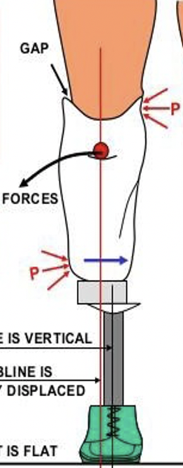 <p>Which gait deviation matches the photo? </p><p>A) Insufficient knee flexion</p><p>B) Premature knee flexion</p><p>C) Lateral displacement</p><p>D) Medial displacement </p>