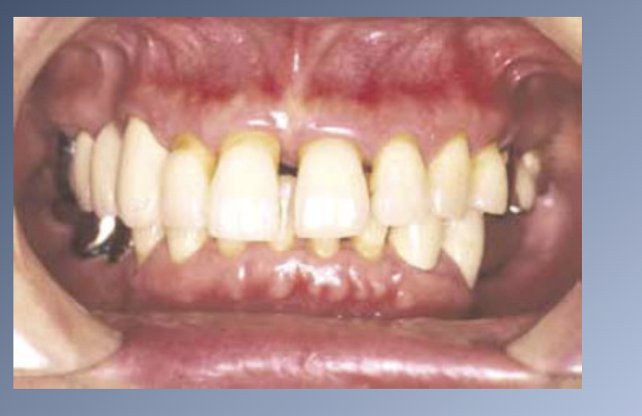 <p><span>Posterior displacement of a “trapped mandible”</span><br><span>1. May relate to myofascial pain</span><br><span>and dysfuntion.</span><br><span>2. Quite rare</span></p><p><span>Flaring and spacing of the maxillary incisors</span><br><span>1. Least common of all three.</span></p><p><span>Distal displacement of the lower incisors</span><br><span>1. Crowding of the lower incisors</span><br><span>2. Decrease in the intercanine distance</span><br><span>3. Not necessary for incisors to be in occlusal contact for crowding to happen.</span><br><span>4. Can happen also in patients with backward rotation of the mandible → dentition is carried forward → light yet lasting pressure by the lower lip → repositioning the protruding incisors somewhat lingually → reduction of arch length.</span></p>
