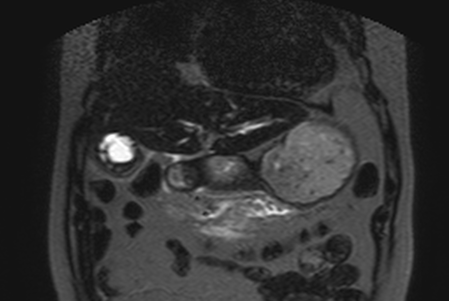 <p>Name MRI sequence and findings</p>