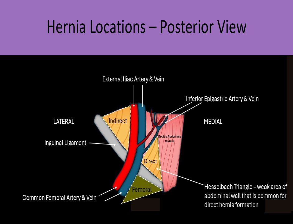 <p>A. direct inguinal hernia</p><p>The Hesselbach triangle is bordered inferiorly by the inguinal ligament, medially by the lateral aspect of the rectus abdominis muscle, and superolaterally by the Inferior Epigastric artery. Intra-abdominal structures move anteriorly through the aponeuroses at the Hesselbach triangle. The inguinal hernia sac lies posterior and medial to the spermatic cord in males, round ligament in females</p>