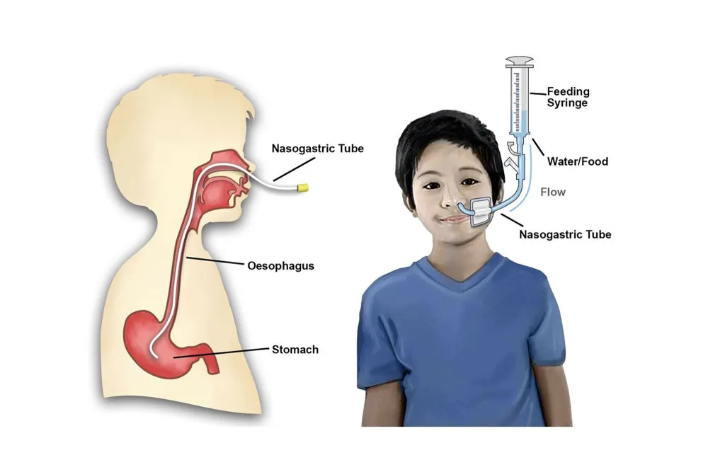 <p>What is a nasogastric (NG) tube?</p>