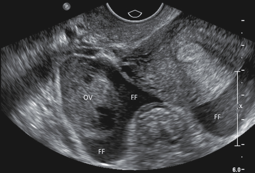 <p>18. Figure 16-19 is a transverse sonogram of the female pelvis. Which of the following statements is not true of this image?</p><p>a. The free fluid is noted within the right adnexa.</p><p>b. The free fluid is noted within the rectouterine pouch.</p><p>c. The free fluid is noted within the posterior cul-de-sac.</p><p>d. The free fluid appears to be anechoic and simple.</p>