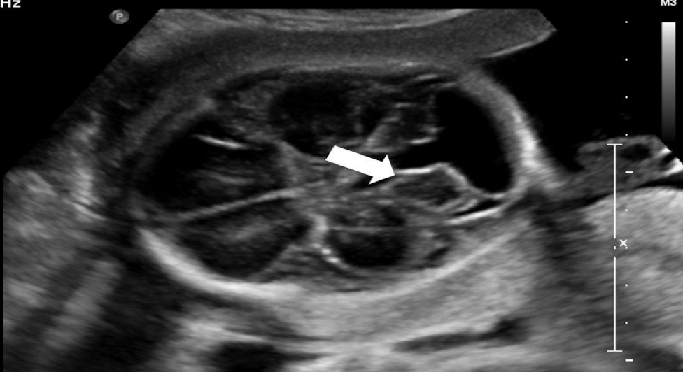 <ul><li><p>agenesis or hypoplasia of cerebellar vermis </p></li><li><p>dilated 4th ventricle</p></li><li><p>enlarged posterior fossa (cisterna magna)</p></li></ul><p></p>