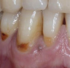 <p>What is the ICDAS for these root caries?</p>