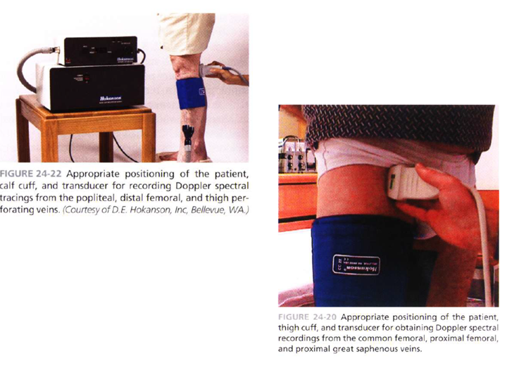 <p>reflux is tested prox to cuff → transducer placed prox to cuff</p><ul><li><p>normal </p><ul><li><p>no flow detected during cuff inflation </p></li></ul></li><li><p><strong>abn</strong></p><ul><li><p><strong>retrograde flow </strong>during cuff deflation due to valvular incompetence </p></li></ul></li></ul><p></p>