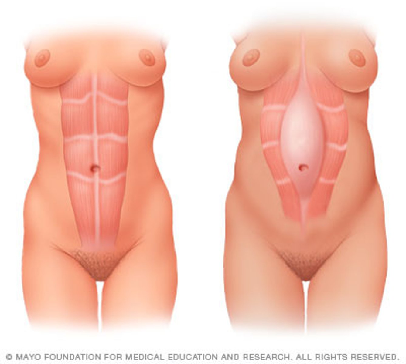 <p>a lot of visceral fat (or in pregnancy) --> separation of rectus abdominal m. --> loss of compression/stabilization from musculature</p>