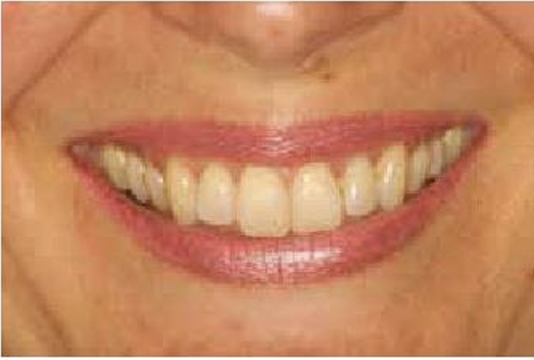 <p>no/slight gingiva display</p>
