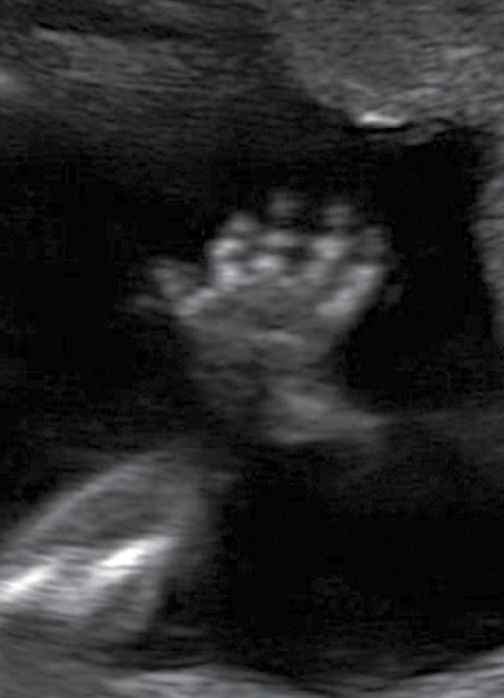 <ul><li><p>narrow thorax with short ribs</p></li><li><p>polydactyly</p></li><li><p>micromelia</p></li><li><p>midline facial cleft</p></li></ul><p></p>