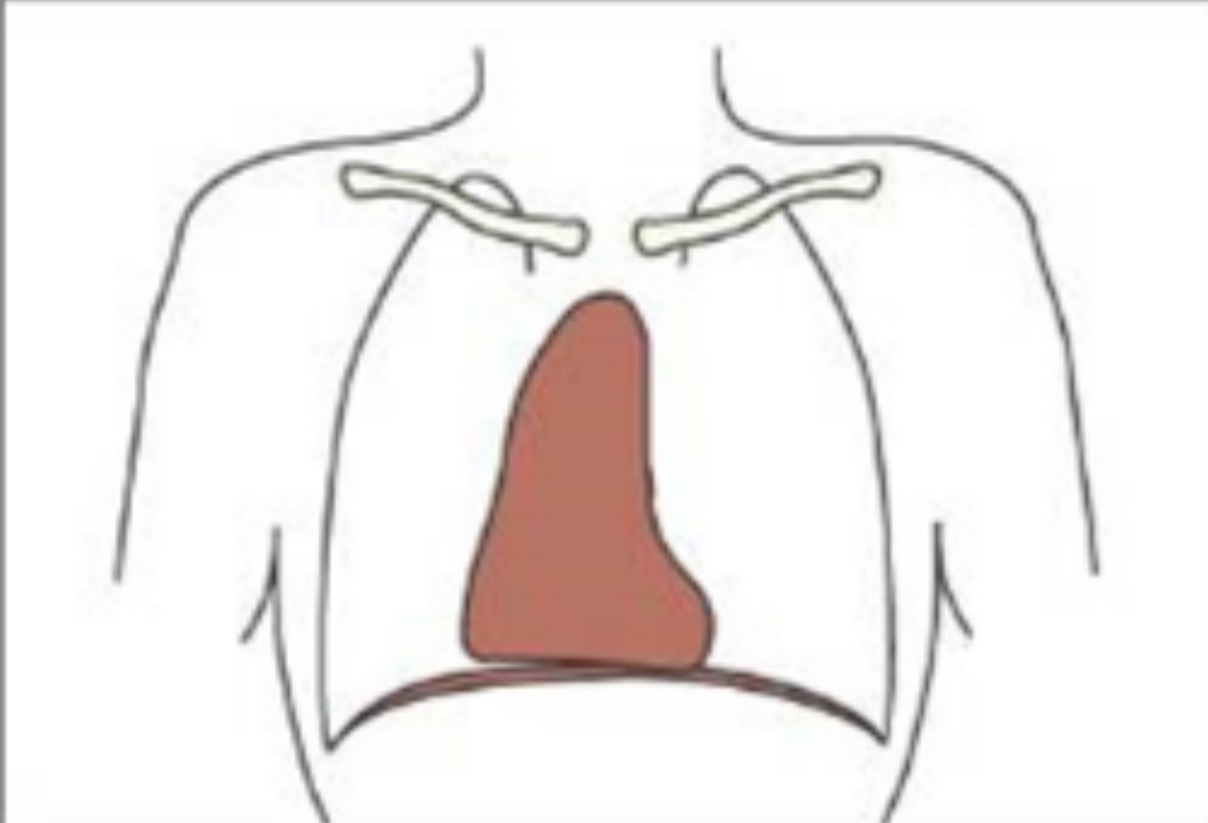 <p>Elongated thorax (not as much as Asthenic)</p><p>Lungs elongated and apices more pointed</p>