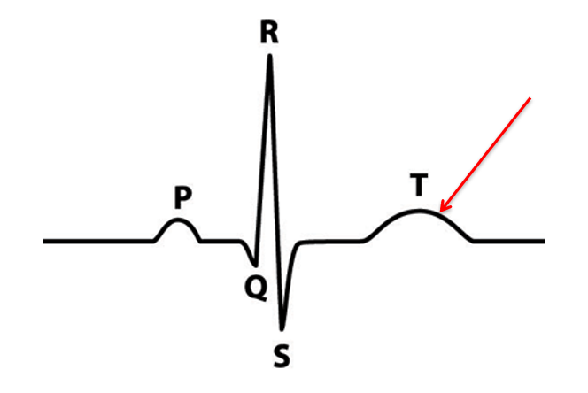<p>What is the condition of the heart reflected at this peak?</p>
