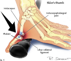<p>Sprain or tear of the ulnar collateral ligament (occurs from falling on outstretched arm and hand, thumb bends back toward hand)</p>