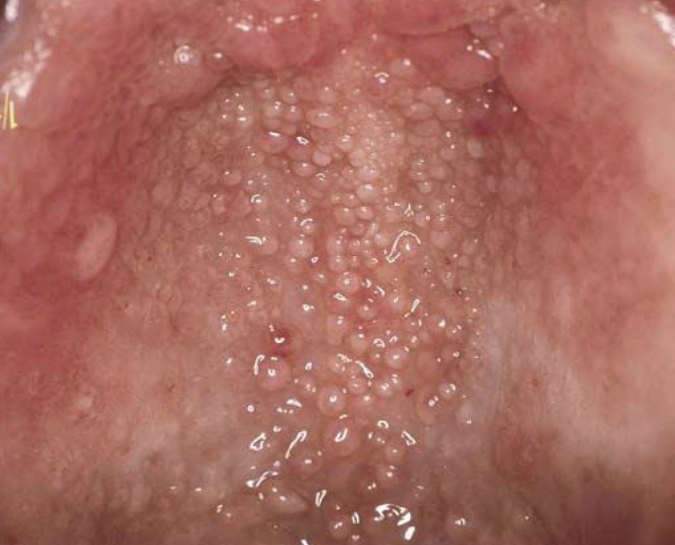 <p>Surface Texture : resembling small projection or elevation found in clusters</p>