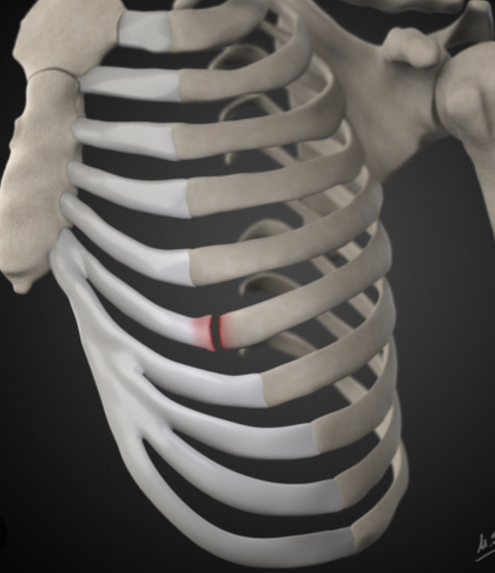 <p>between costal cartilage and rib</p>