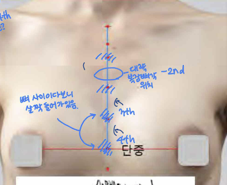 <p>앞정중선 위, 4째 갈비사이공간 높이</p>