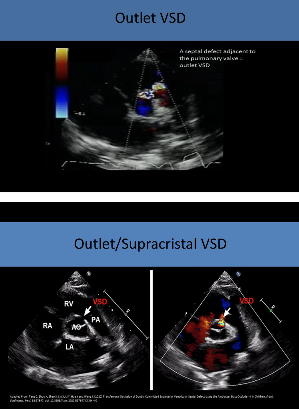 <p>in RVOT near pulmonic valve</p><ul><li><p>inferior to left coronary leaflet of ao valve and adjacent to pulmonic valve </p></li></ul><p></p>