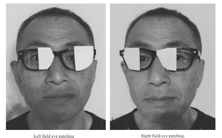 <p>quick, effective, inexpensive tool to decrease unilateral inattention; occluding one ye facilitates attention and visual saccades to contralateral side</p><ul><li><p>caution: studies found that once removed, did not translate into function</p></li><li><p>hemi field patching demonstrated greater improvements in functional independence</p></li></ul><p></p>
