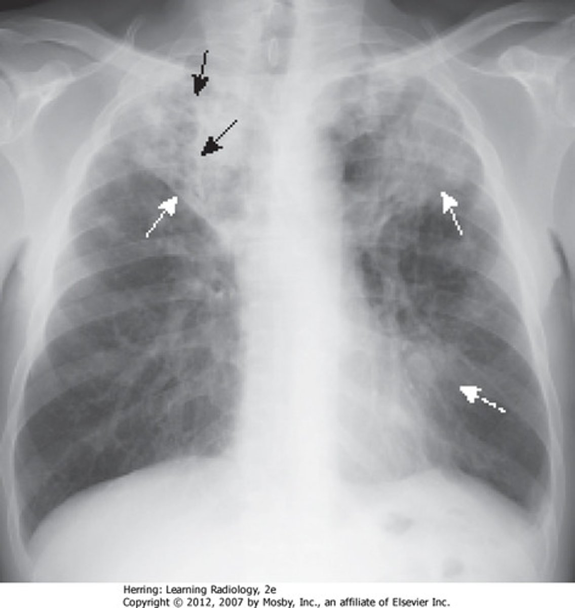 <p>A bacterial infectious disease that affects humans and cattle</p><p>- Kills cells and tissues, mainly the lungs</p><p>- Has thick cell wall</p><p>- Diagnosed with x-ray</p><p>- Transmitted through airborne droplets</p>