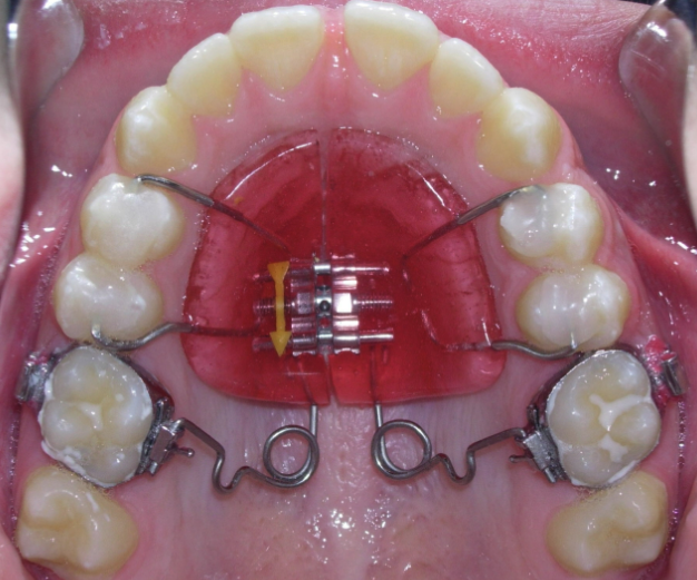 <p>Molar distalization</p>