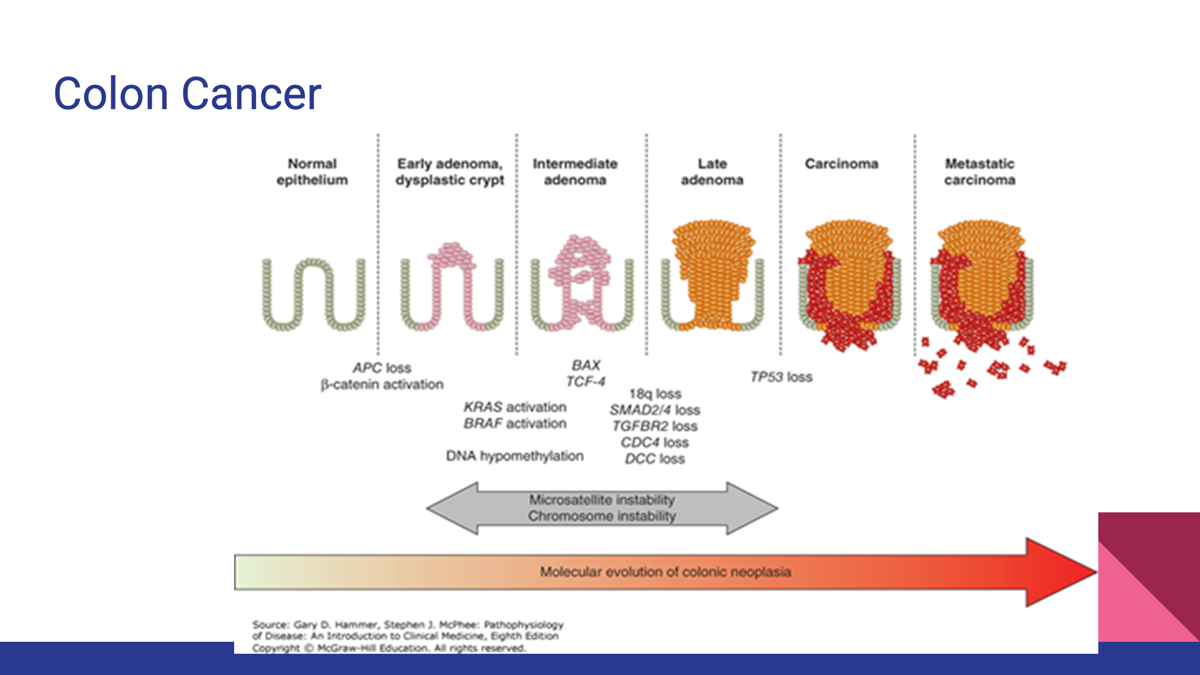 <p><span>A </span><strong>carcinoma</strong><span> arising from epithelial cells of the colon.</span></p><p></p><p></p><p>Colon Carcinoma</p><ul><li><p>A <strong>carcinoma</strong> arising from epithelial cells of the colon.</p></li><li><p>Develops through a series of genetic alterations:</p><ul><li><p><strong>APC mutation</strong> → adenomatous polyp formation</p></li><li><p><strong>KRAS activation</strong> → polyp growth</p></li><li><p><strong>TP53 loss</strong> and other mutations → invasive carcinoma</p></li></ul></li><li><p>Most colon cancers are <strong>adenocarcinomas</strong></p></li></ul><p></p><p></p>