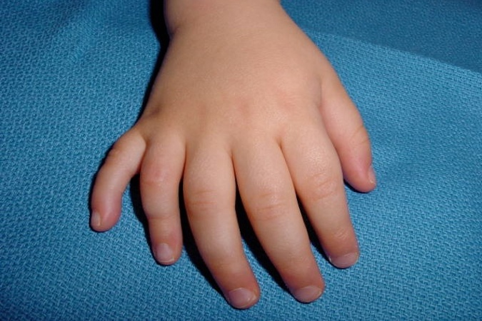 <p>Fifth finger polydactyly</p>