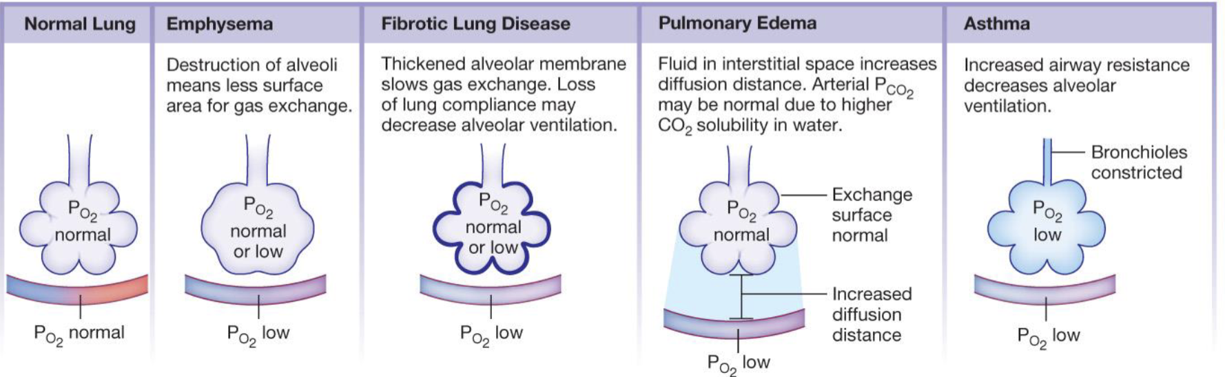 <ul><li><p>emphysema (destruction of alveoli means less surface area for gas exchange)</p></li><li><p>fibrotic lung disease (thickened alveolar membrane slows gas exchange and loss of lung compliance may decrease alveolar ventilation)</p></li><li><p>pulmonary edema ( fluid in the interstitial space increases diffusion distance and arterial P<sub>CO2</sub> may be normal due to higher CO2 solubility in water)</p></li><li><p>asthma (increased airway resistance decreases alveolar ventilation)</p></li></ul><p></p>