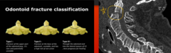 <p>Fracture of the dens, or peg at C2</p><p>3 subtypes, treated differently depending on location of fracture</p><p> • ex: TII = surgical bc cut off blood supply</p>