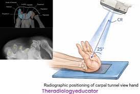 <ol><li><p><span style="background-color: transparent;"><strong><u>Carpal canal (tunnel) Inferosuperior Projection w/ Gaynor Hart Method </u>=</strong> CR 1st inch distal to base of 3rd metacarpal 25-30 degrees to hand; hyperextend wrist while holding fingers back making the long axis of the metacarpals near vertical + rotate wrist 10 degrees toward radius </span></p></li></ol><ul><li><p><span style="background-color: transparent;"><strong><em>Eval. criteria</em></strong> = carpal sulcus demonstrated, pisiform + hamate separated + scaphoid in profile&nbsp;&nbsp;</span></p></li></ul><p></p>