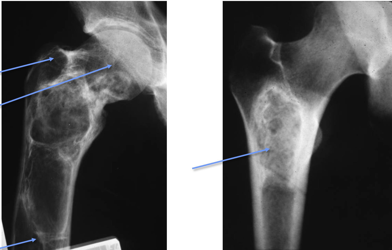 <p>What tumour like disorder is this, what can you see?</p>