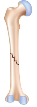 <p>Diagonal fracture with fragments remaining <strong>aligned</strong>, caused by <strong>angled force</strong> or bending trauma, bone alignment is preserved.</p>