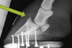 <p>what complication is this after a neurectomy</p>