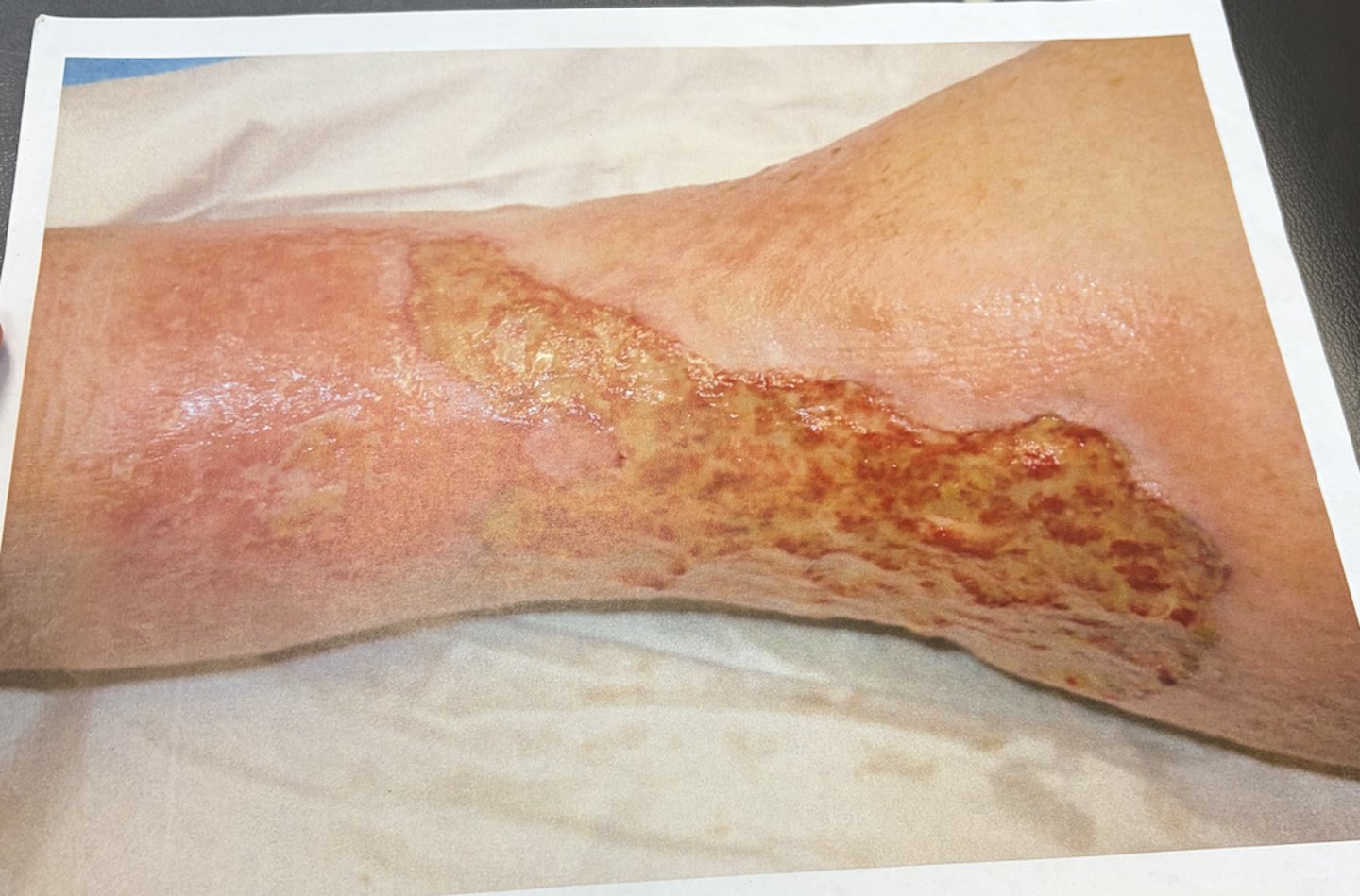 <p>how would you care for this wound?</p>