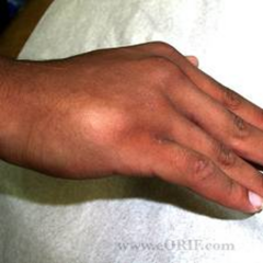 <p>- Pain & swelling over fx area & depression of the affected knuckle (have pt make a fist)</p><p>- Ensure intact neurovascular status</p><p>Tx:</p><p>- May require reduction in ED (consult Ortho if significant displacement)</p><p>- Patient requires Ulnar Guttar splint & Ortho follow-up</p>