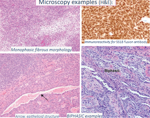 <ul><li><p>vascular neoplasm → from endothelium or BV support cells</p><ul><li><p>benign →<u> kaposi sarcoma</u> via HHV8, epithelioid via WWTR1-CAMTA1 fusion</p></li><li><p>malignant → angio sarcoma w/ endothelial differentiation (post radiation breast)</p></li></ul></li><li><p>vascular malformation → venous, capillary, lymphatic, arterial components</p></li><li><p>synovial sarcoma → biphasic (glandular + spindle) + monophasic (only spindle),<strong> t(x;18)(p11;q11), </strong>TLE1+</p></li></ul><p></p>