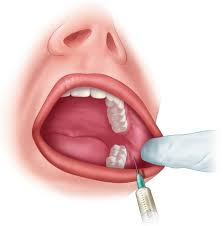 <p>What landmarks are anesthetized with a buccal block?</p><p>tissue</p><p></p>