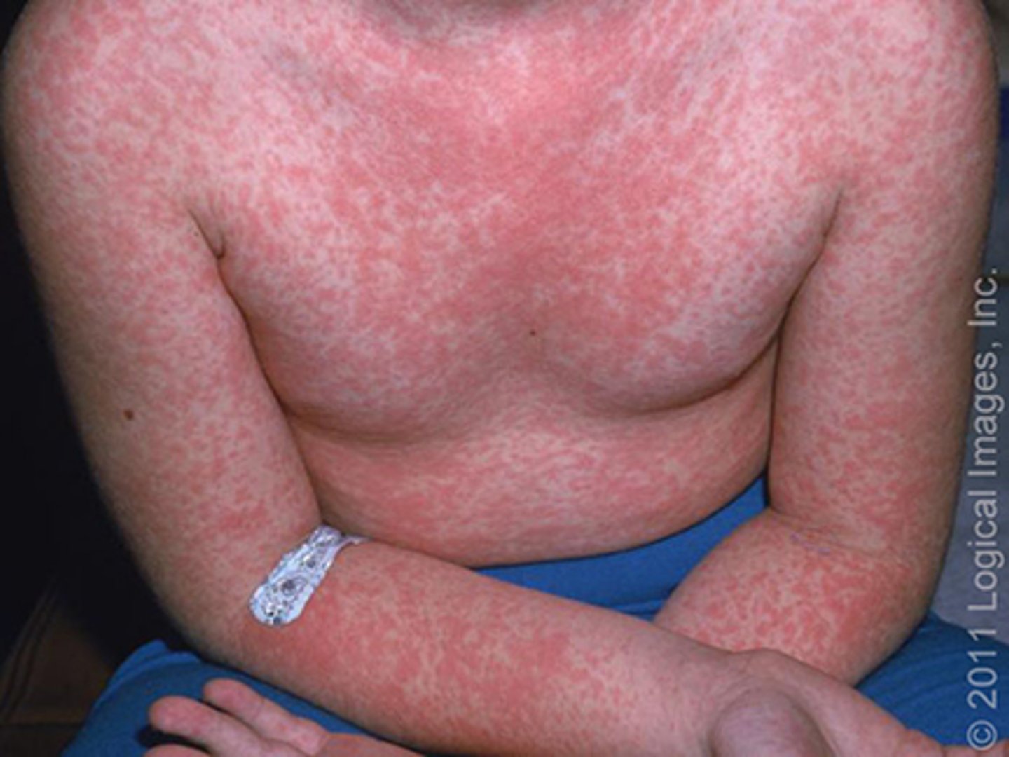 <p>generalized rash/eruption</p><p>- acute scarlet fever/strep</p><p>-acrodermatitis</p><p>-fifths disease</p><p>-measles</p><p>-HF&amp;M</p>