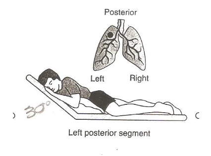 <p>left posterior segment </p>