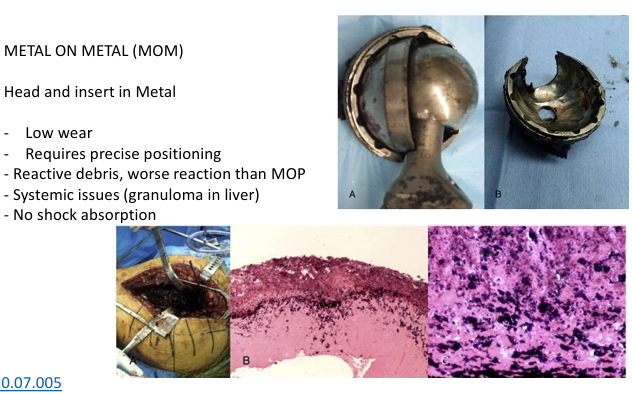 <p>Head and insert in Metal </p><ul><li><p>Low wear Requires precise positioning</p></li><li><p>Reactive debris, worse reaction than MOP</p></li><li><p>Systemic issues (granuloma in liver)</p></li><li><p>No shock absorption</p></li></ul><p></p>