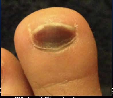 <p>Bleeding beneath the nail plate caused by trauma, resulting in pain and discoloration.</p>